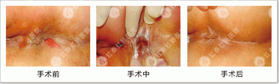 HCPT肛泰方法治肛裂过程