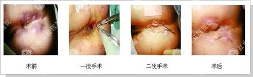 工人复杂肛瘘两次手术终-yebo肛肠医院_福州肛肠专科