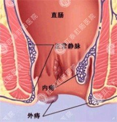 冬季天气降温，需警惕内痔发作！