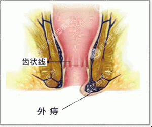 福州女性内痔疮怎么治疗？