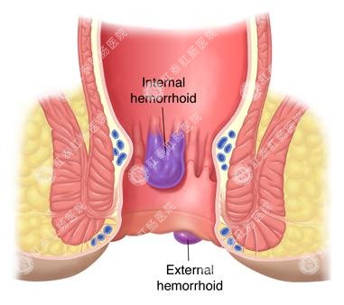 痔疮