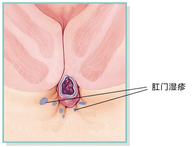 肛门湿疹